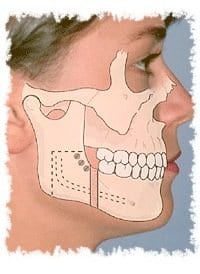 Schema anatomique apres chirurgie orthognathique repositionnement mandibulaire
