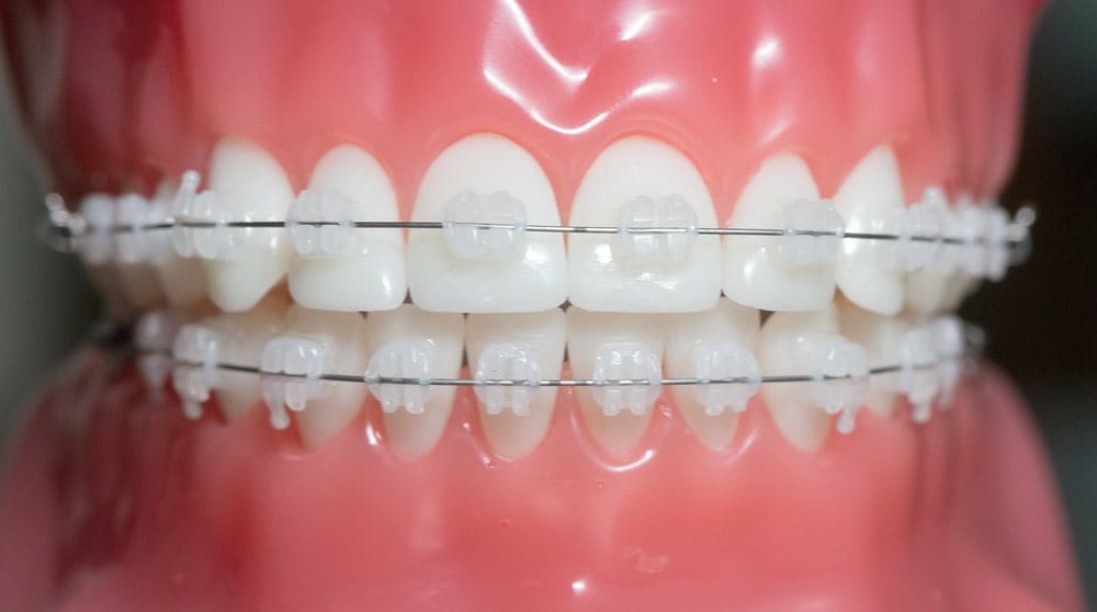 Orthodontic fixed bracket models