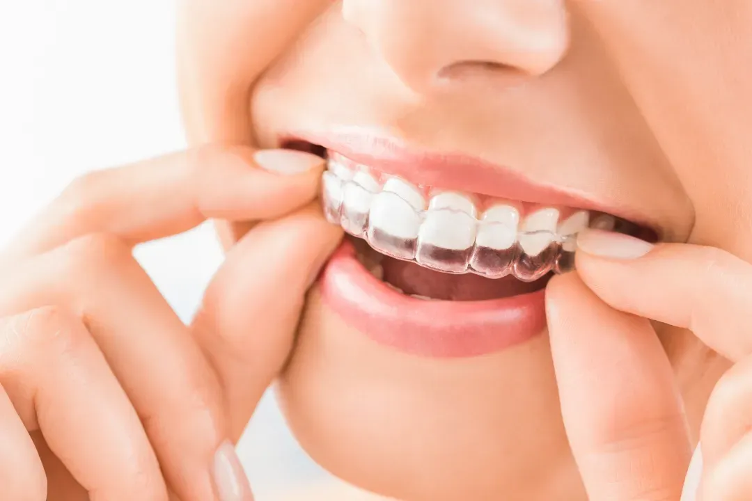 Aligneurs SPARK Invisalign pour ados