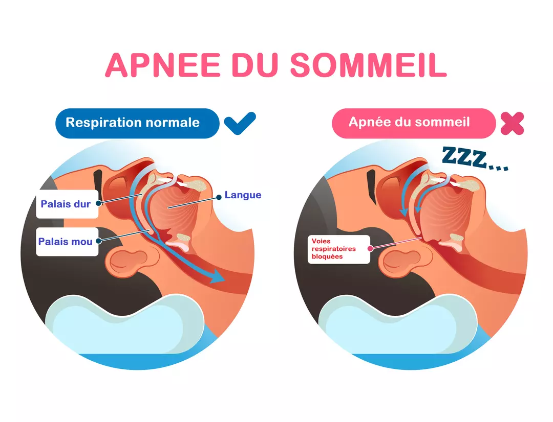 Sch&eacute;ma de l'apn&eacute;e du sommeil : respiration normale vs voies respiratoires bloqu&eacute;es
