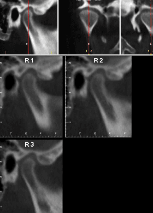 Scan CBCT de l'articulation temporo-mandibulaire