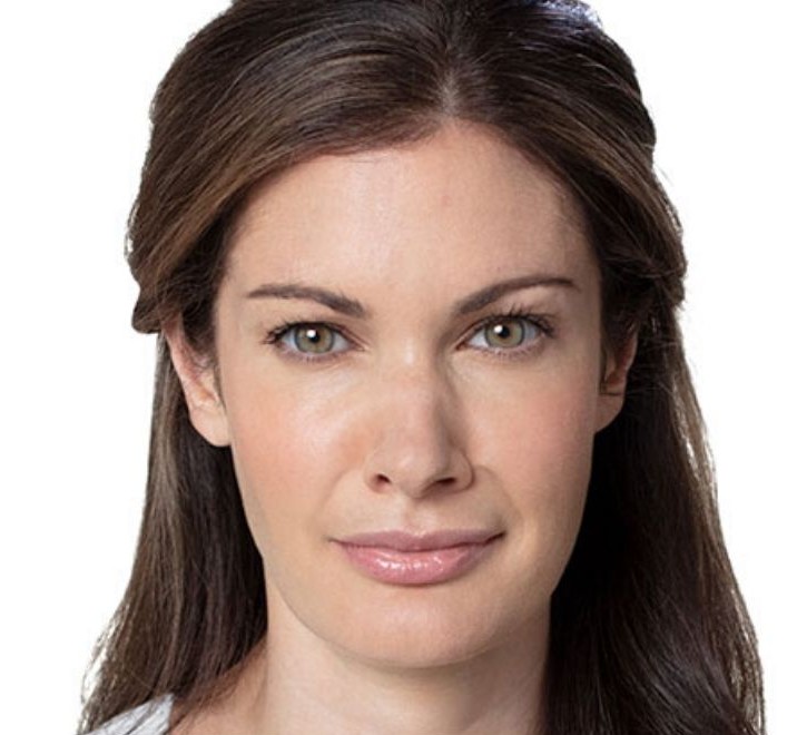 Après injection Botox - rides du front lissées naturellement