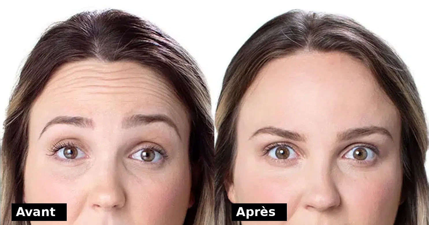 Botox avant et après - réduction des rides du front à St-Eustache