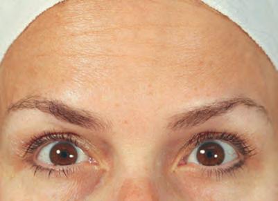 Apr&egrave;s Botox rides du front