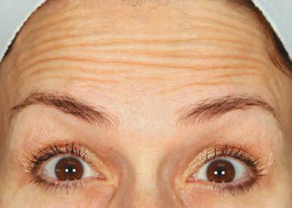 Avant Botox rides du front