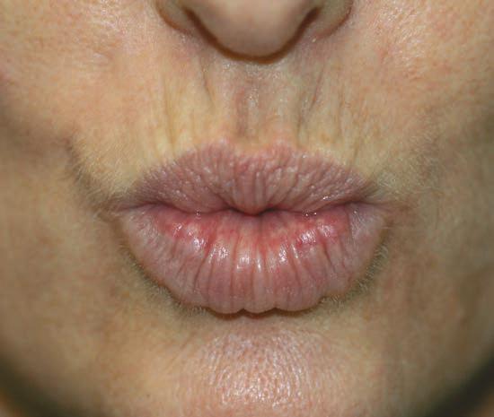 Avant Botox rides du fumeur