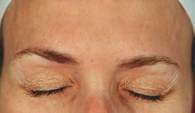 Apr&egrave;s Botox rides du lion