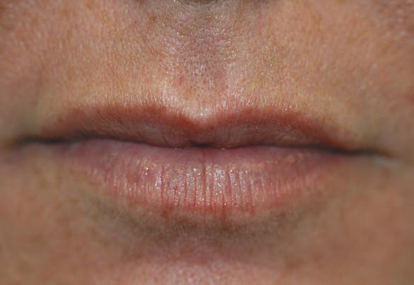 Apr&egrave;s Botox lip flip