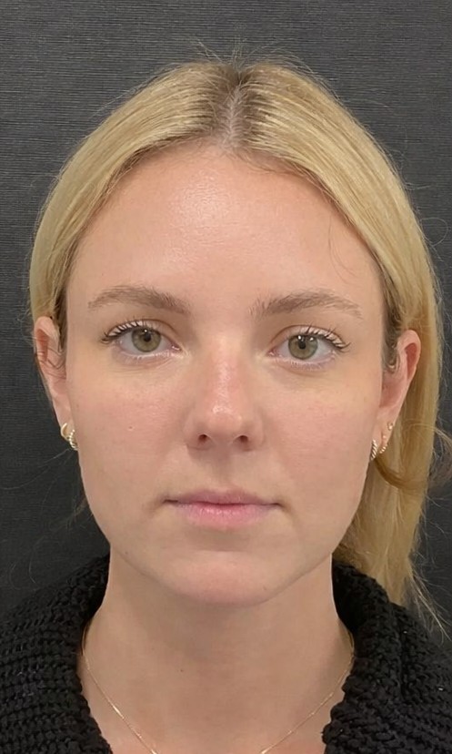 Apr&egrave;s Botox mass&eacute;ter