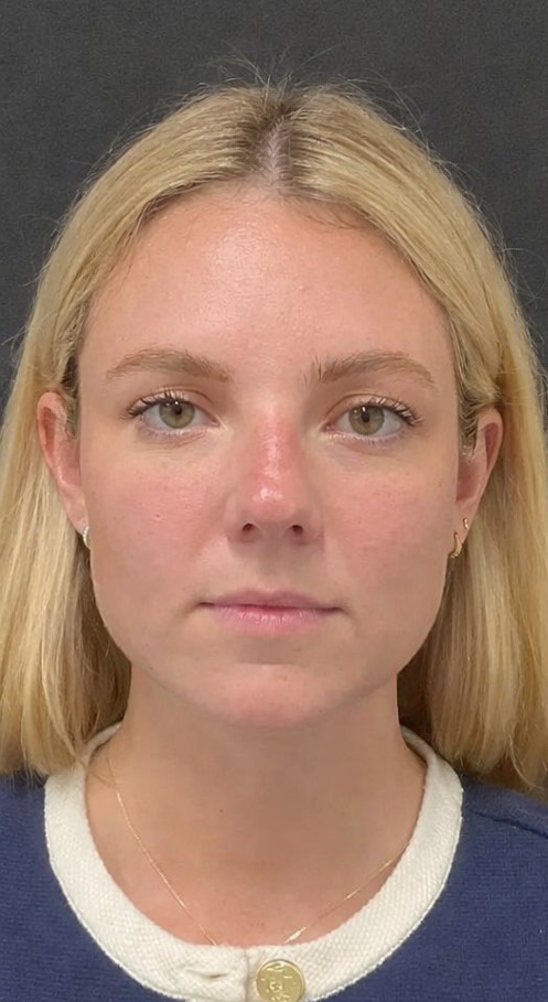 Avant Botox mass&eacute;ter