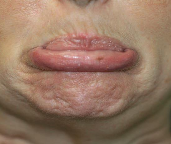 Avant Botox menton peau d'orange