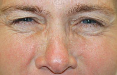 Apr&egrave;s Botox nasalis