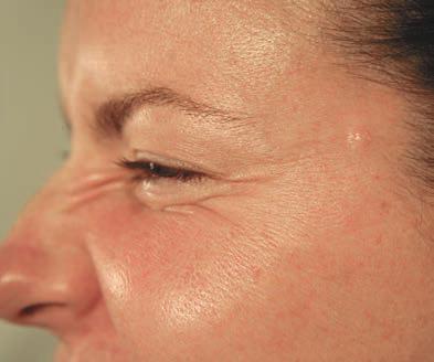 Apr&egrave;s Botox pattes d'oie