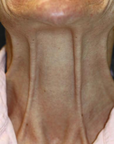 Avant Botox bandes platysmales