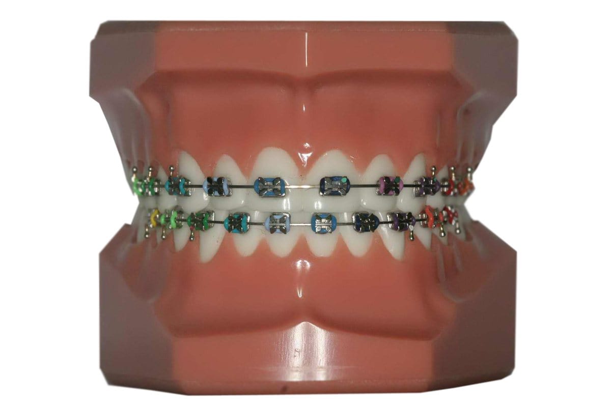 Broches orthodontiques avec ligatures colorées