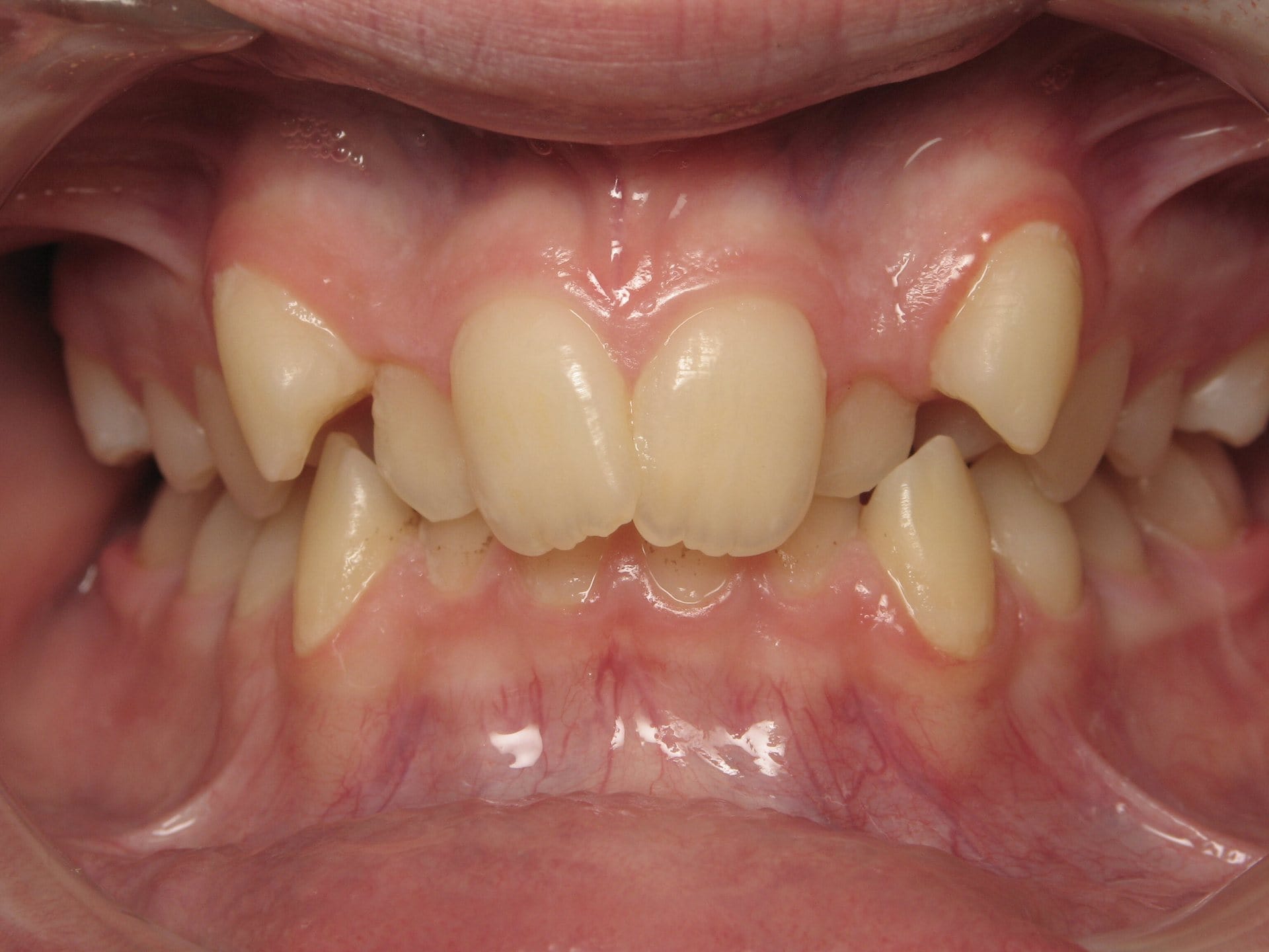 Chevauchement dentaire