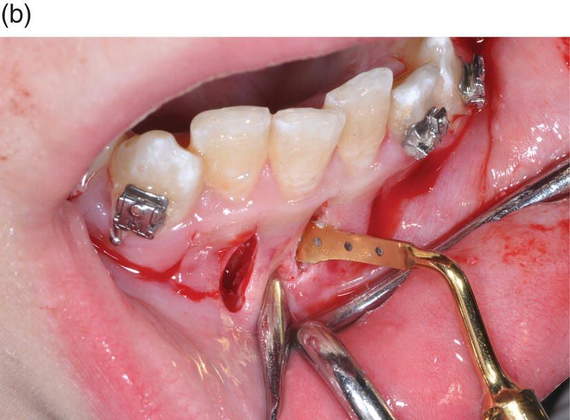 Corticotomie orthodontique