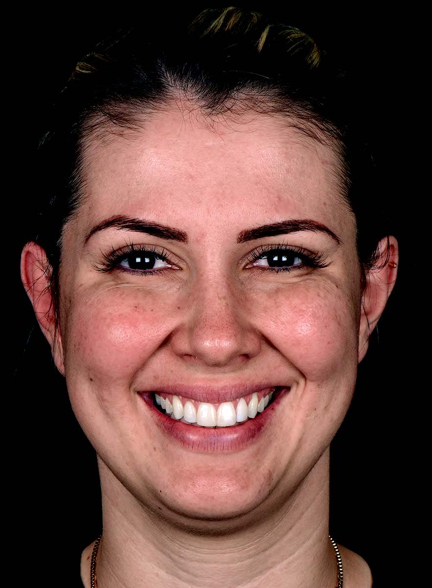 Sourire gingival - Après traitement