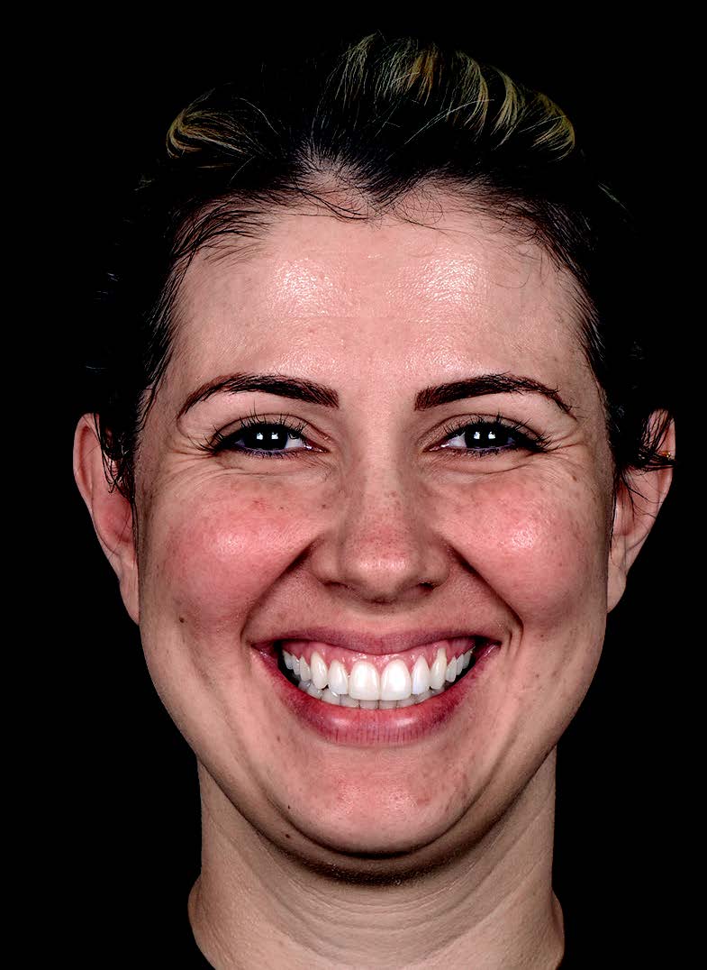 Sourire gingival - Avant traitement