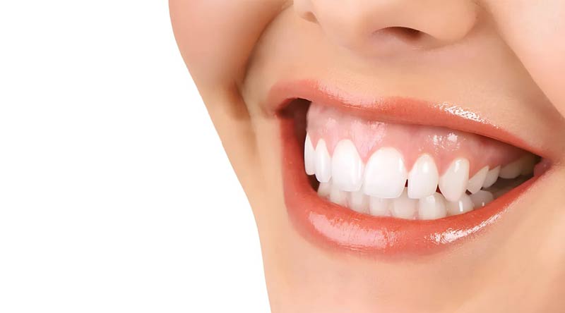 Sourire gingival - exposition excessive des gencives