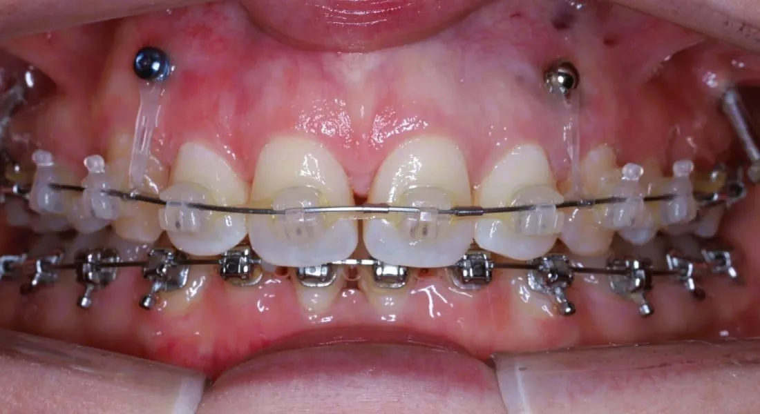 Traitement orthodontique avec mini-vis pour sourire gingival
