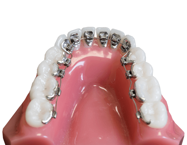 Lingual orthodontics - braces behind the teeth