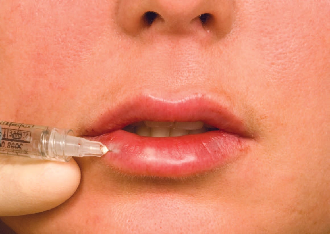 Hyaluronic acid dermal filler injection for lips in Saint-Eustache