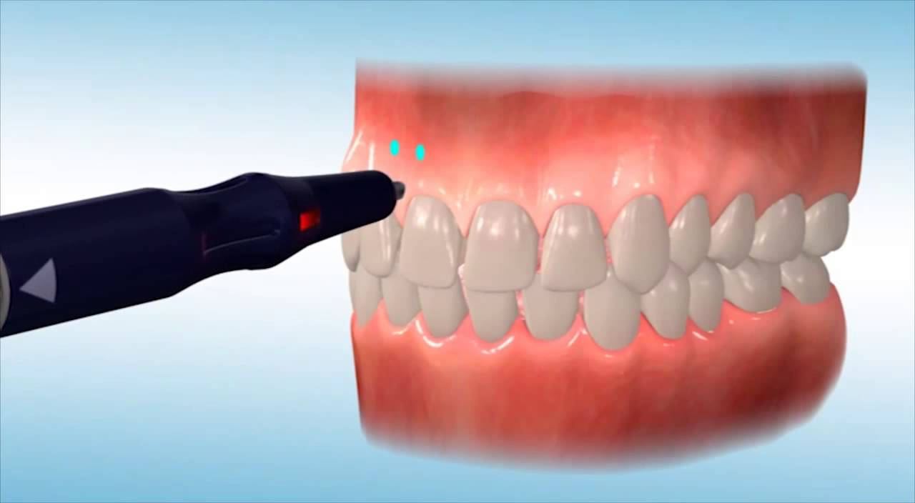 Micro-osteoperforations to accelerate orthodontic treatment