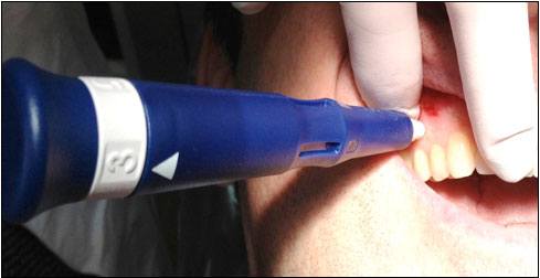 Micro-osteoperforation Propel pour orthodontie acceleree