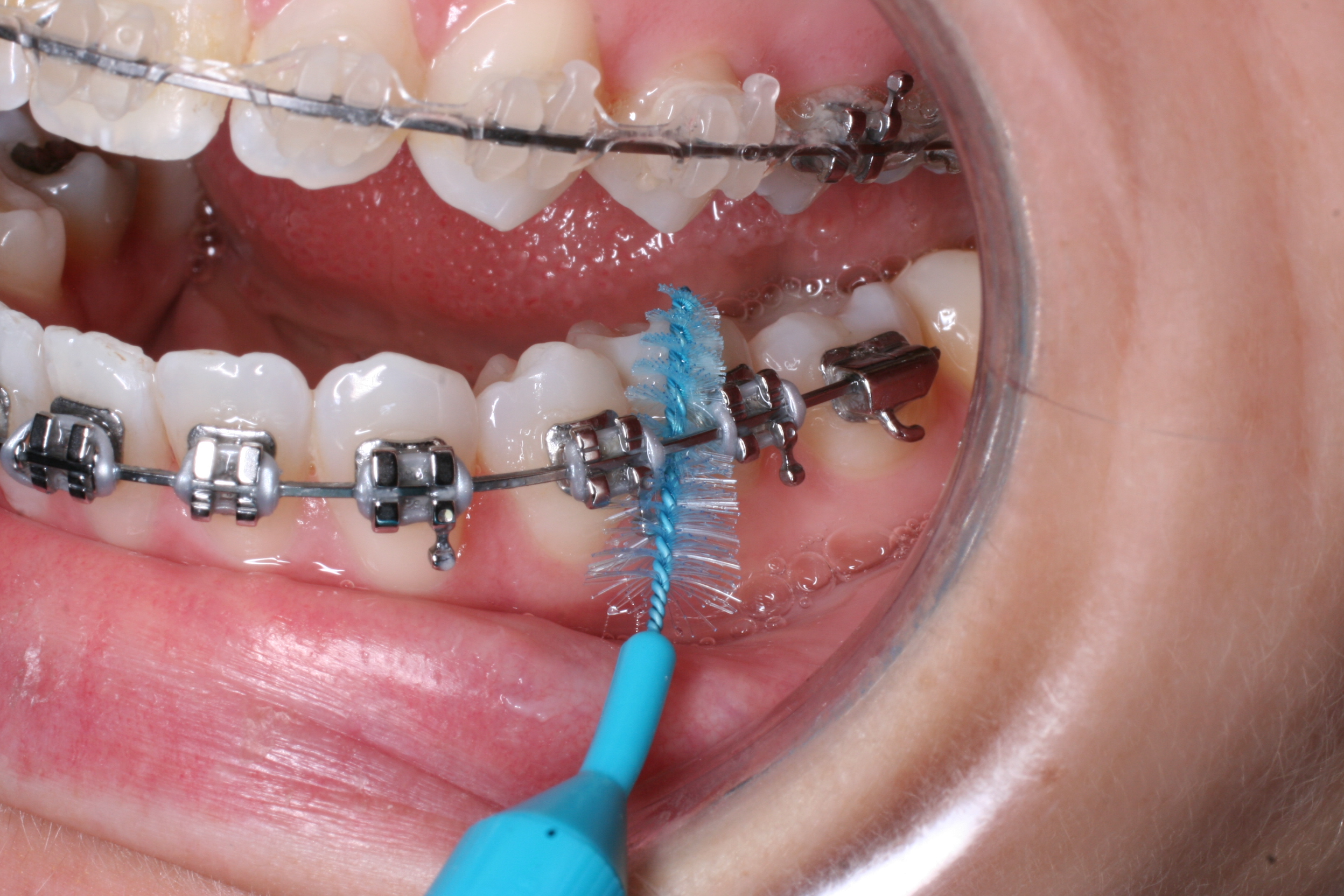 Brushing teeth with orthodontic braces 45 degree technique