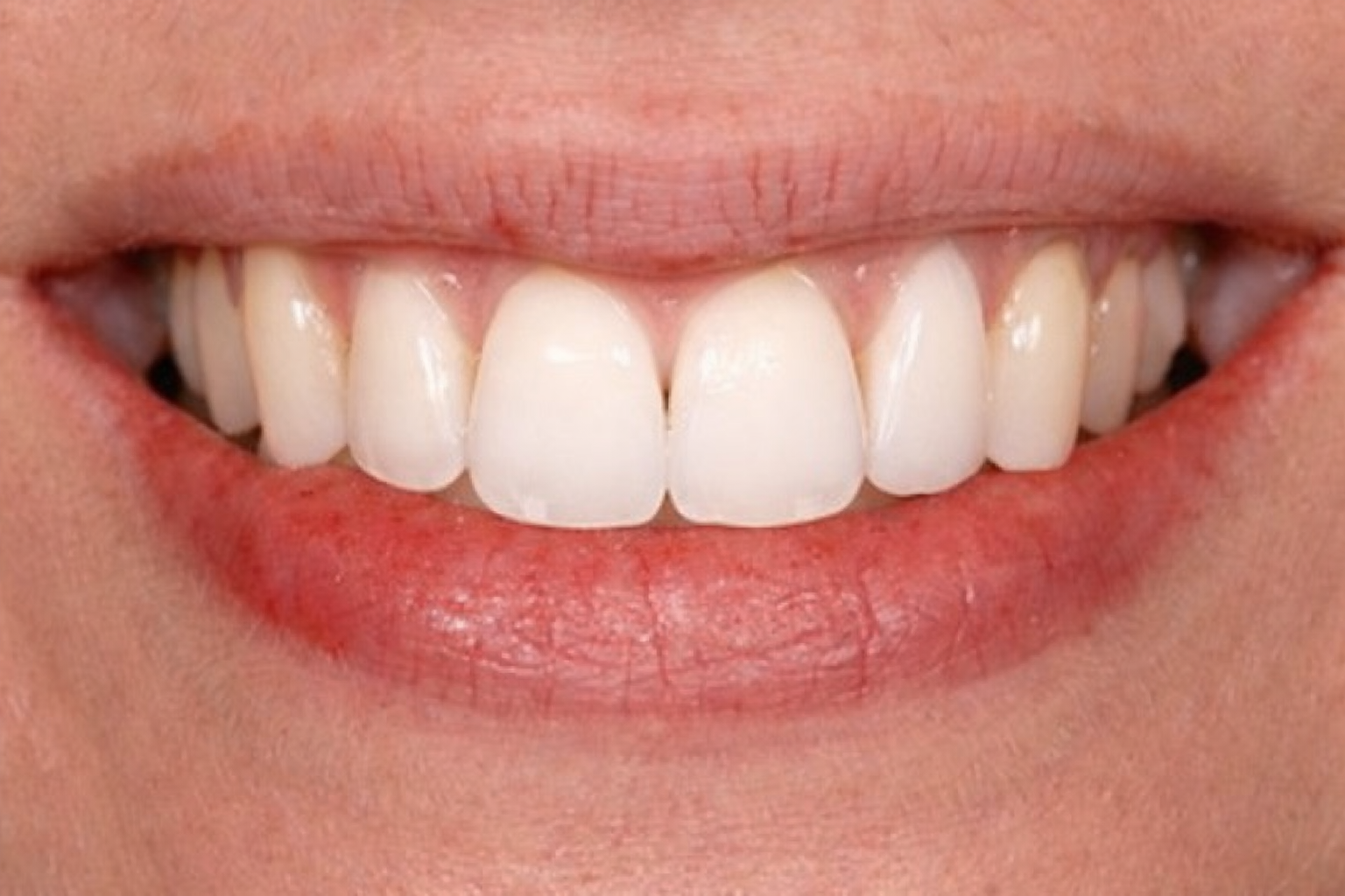 Mini-aesthetics - smile and lip analysis