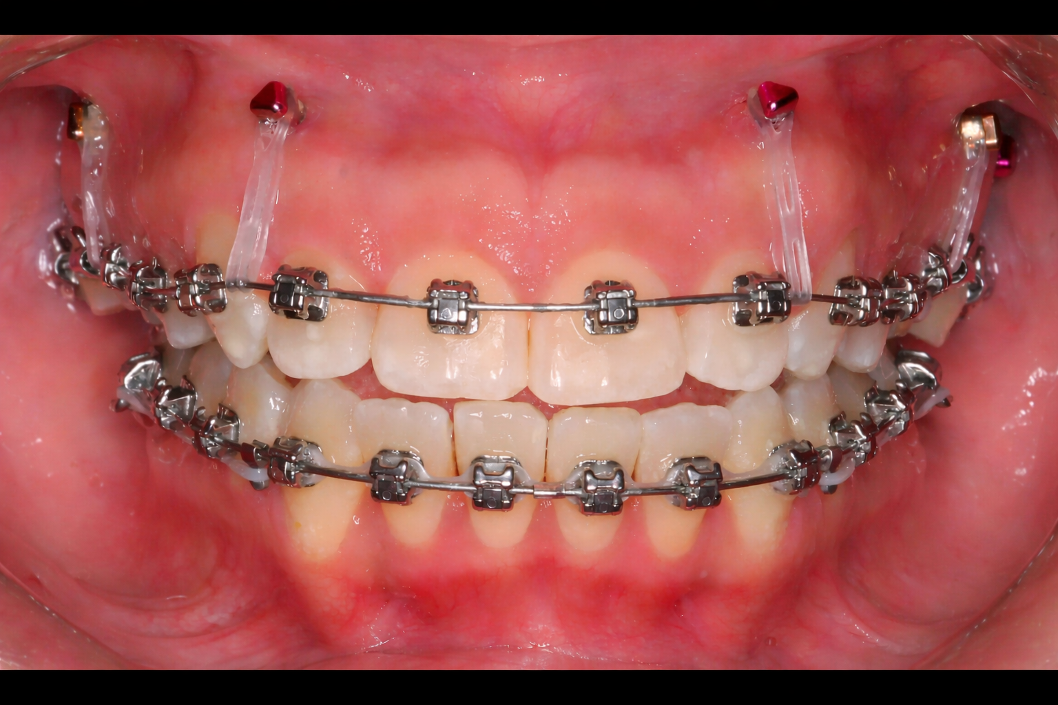 Mini-vis TAD pour béances antérieures avec broches