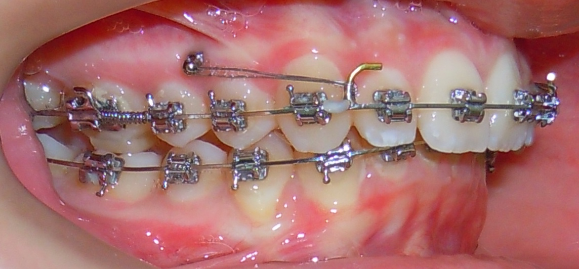 Mini-vis orthodontiques TADs avec broches en bouche