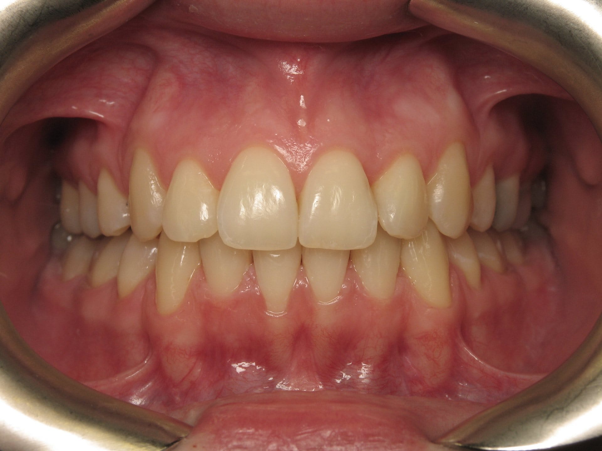 Blocage de la mâchoire