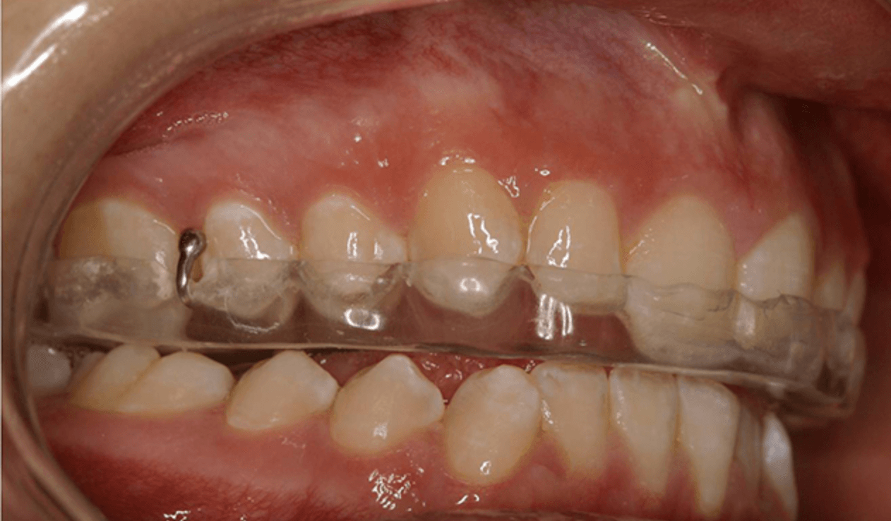 Goutti&egrave;re occlusale sur mesure pour traitement ATM