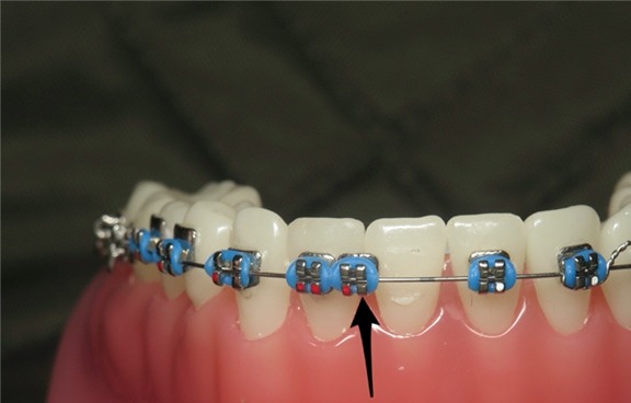 Detached orthodontic bracket sliding on the wire - needs rebonding